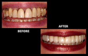 cosmetic dentistry omaha nebraska Dr. Jared Bolding veneers