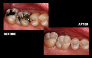 Composite Fillings - Dr. Jared Bolding, Omaha Cosmetic Dentist