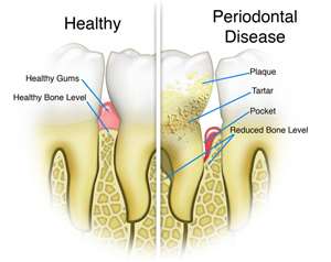 Root Planing and Scaling - Preventative Dentistry - Dr. Jared Bolding - Omaha, Nebraska