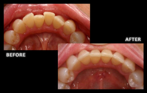 Inman Aligner Results - Omaha Cosmetic Dentist - Dr. Bolding