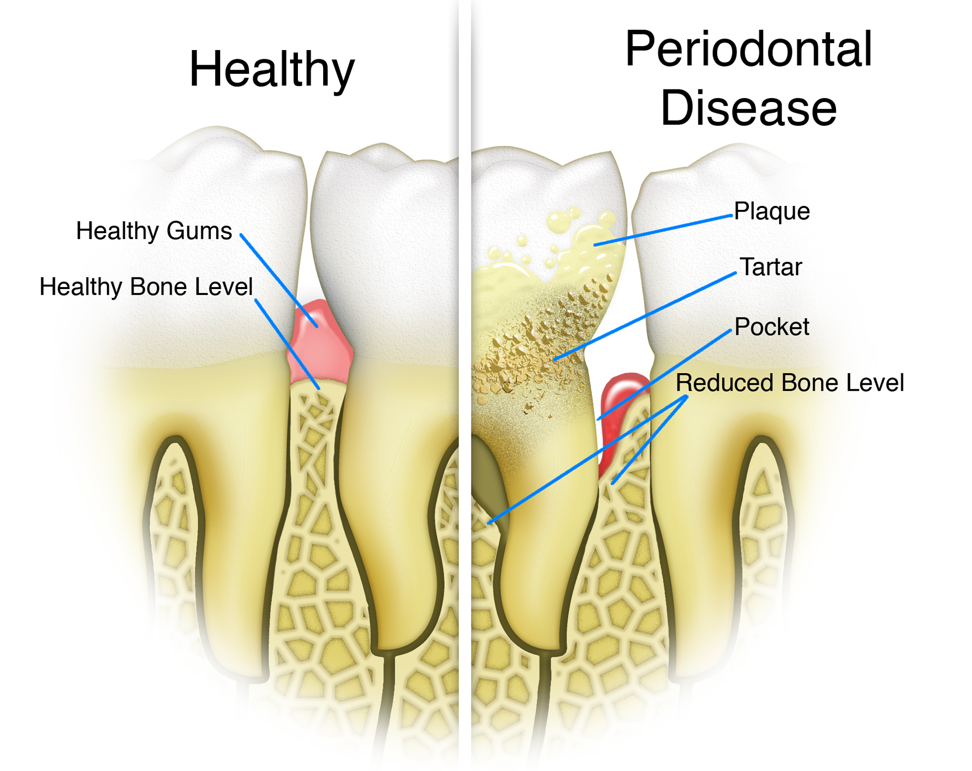 Periodontal-Disease Dr. Bolding cosmetic dentist omaha