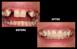 Zuerlein Dental, Implant Dentistry, Missing Lateral Incisors Replaced With Implants