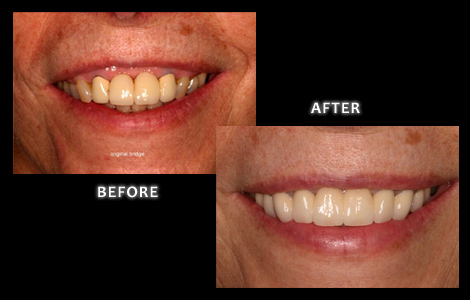 Zuerlein Dental, Omaha Cosmetic Dentist, Gum Surgery and All-Ceramic Crowns