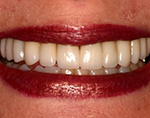 Cosmetic and Restorative Dentistry - Dr. Bolding Omaha Cosmetic Dentist
