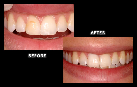 Cosmetic Dentistry, Old Failing Composite Replaced With All Ceramic Crown - Zuerlein Dental