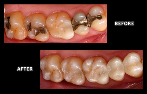 Cosmetic Dentistry, Amalgam Fillings Composite Bonded Fillings - Zuerlein Dental