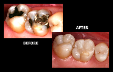 Old Amalgam Fillings Replaced With Composite Fillings - Zuerlein Dental