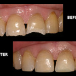 Restorative Dentistry, Worn Teeth Repaired with Composite Bonding – Zuerlein Dental