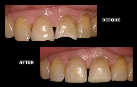 Restorative Dentistry, Worn Teeth Repaired with Composite Bonding - Zuerlein Dental