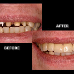 Restorative Dentistry, Worn Stained Teeth Corrected With Full Mouth Restoration – Zuerlein Dental