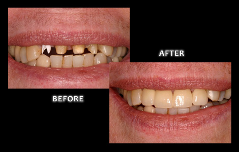 Restorative Dentistry, Worn Stained Teeth Corrected With Full Mouth Restoration - Zuerlein Dental