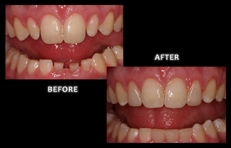 Cosmetic Dentistry, Lower Anterior Composite Bonding - Zuerlein Dental