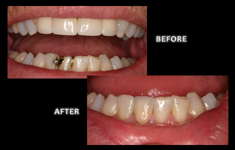 Restorative Dentistry, Failing Amalgam and Gold Restorations Replaced with New All Ceramic Crown and Bonded Fillings - Zuerlein Dental