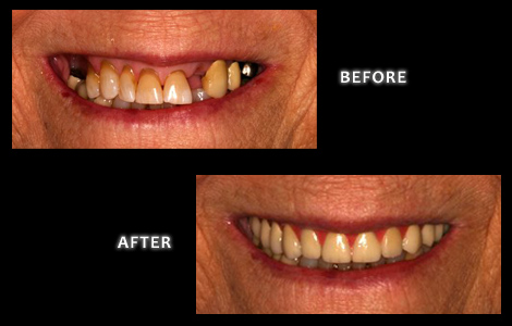 Cosmetic Dentistry, New Upper Restoration - Zuerlein Dental
