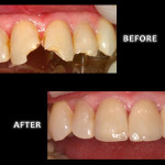 Restorative Dentistry, Damaged Incisors Repaired with Ceramic Crowns – Zuerlein Dental