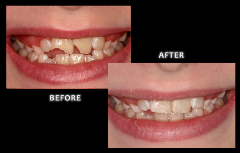 Restorative Dentistry, Damaged Incisors Repaired with Composite Bonding - Zuerlein Dental