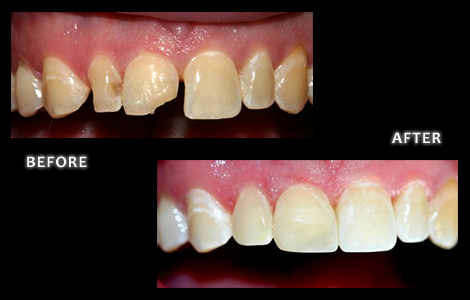 Cosmetic Dentistry, Chipped Incisor Repaired with Composite Fillings - Zuerlein Dental