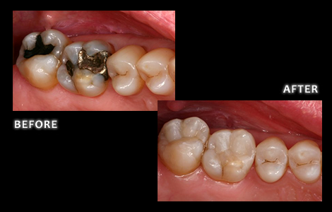 Restorative Dentistry, Amalgam Fillings Replaced With Composite Fillings - Zuerlein Dental