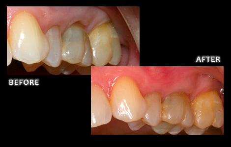 Upper Left Gum Recession Corrected With Surgery Free Pinhole Technique - Dr. Jared Bolding DDS