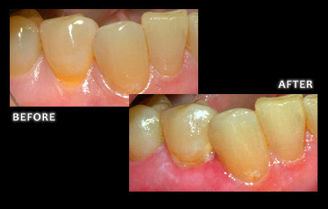 Lower Gum Recession Corrected With Surgery Free Pinhole Technique - Dr. Jared Bolding DDS