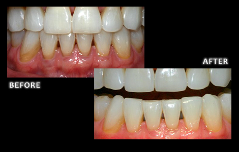 Chao Pinhole Gum Recession Before and After - Brian W Zuerlein DDS
