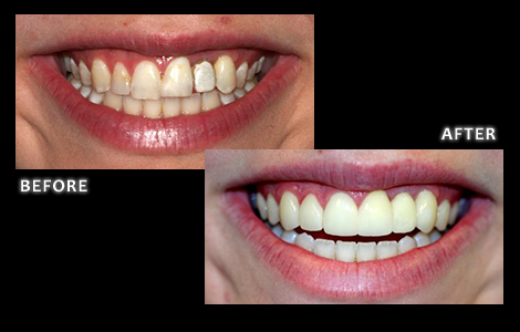 Omaha Cosmetic Dentist Dr. Bolding, Implants, Crowns and Veneers