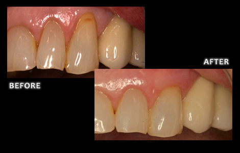 Gum Recession Correction - Omaha Cosmetic Dentist - Dr. Bolding