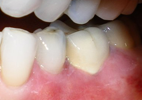 Chao Pinhole For Gum Recession - Dr. Bolding Omaha Cosmetic Dentist