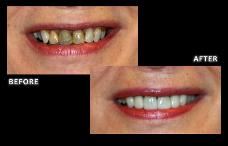 Smile Makeover - Omaha Cosmetic Dentist - Brian W Zuerlein DDS