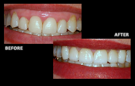 Before and After Ceramic Crowns - Brian W Zuerlein DDS