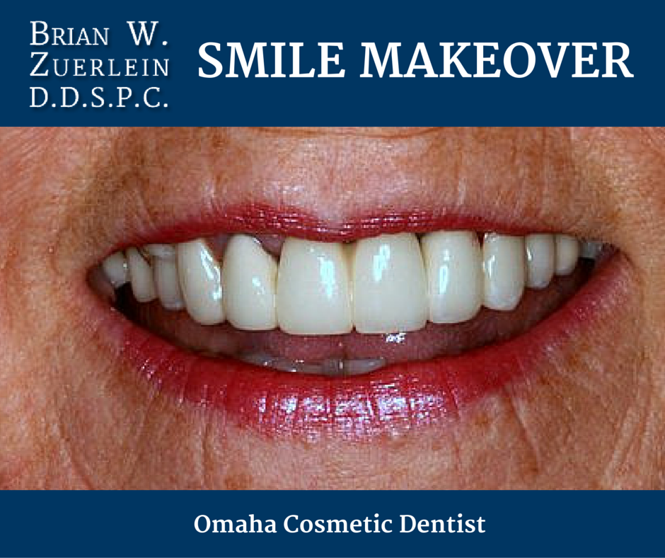 Omaha Cosmetic Dentist, Brian Zuerlein - Smile Makeover, Crowns, Bridges