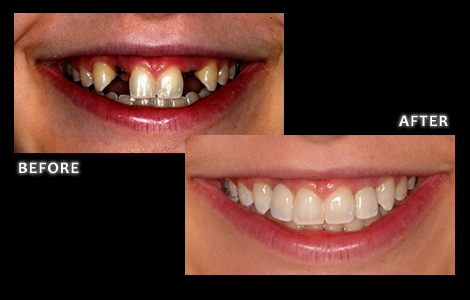 Missing Lateral Incisors Fixed With Implants - Dr. Jared Bolding - Omaha Cosmetic Dentist