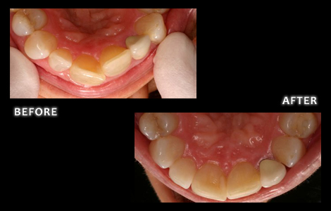 Inman Aligner - Teeth Straightening - Dr. Bolding Omaha Cosmetic Dentist