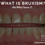 Bruxism, Teeth Grinding – Omaha Cosmetic Dentist – Dr. Jared Bolding