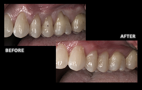 Chao Pinhole Technique to Correct Upper Gum Recession