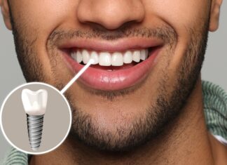 Implant Dentistry in Omaha - Dr. Bolding Dentistry - Omaha Dentist