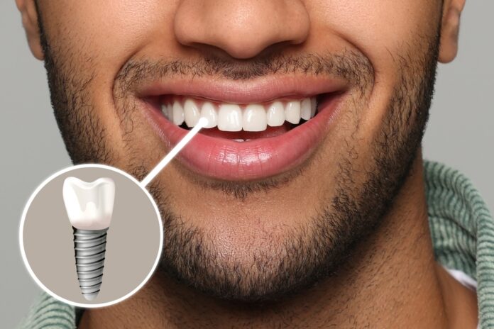 Implant Dentistry in Omaha - Dr. Bolding Dentistry - Omaha Dentist