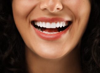 when to get veneers in Omaha, Nebraska